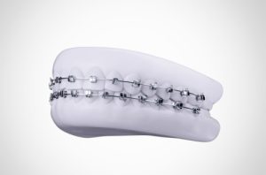 Full view of teeth with bracket system