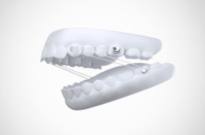 Motion Pro Clear on teeth example