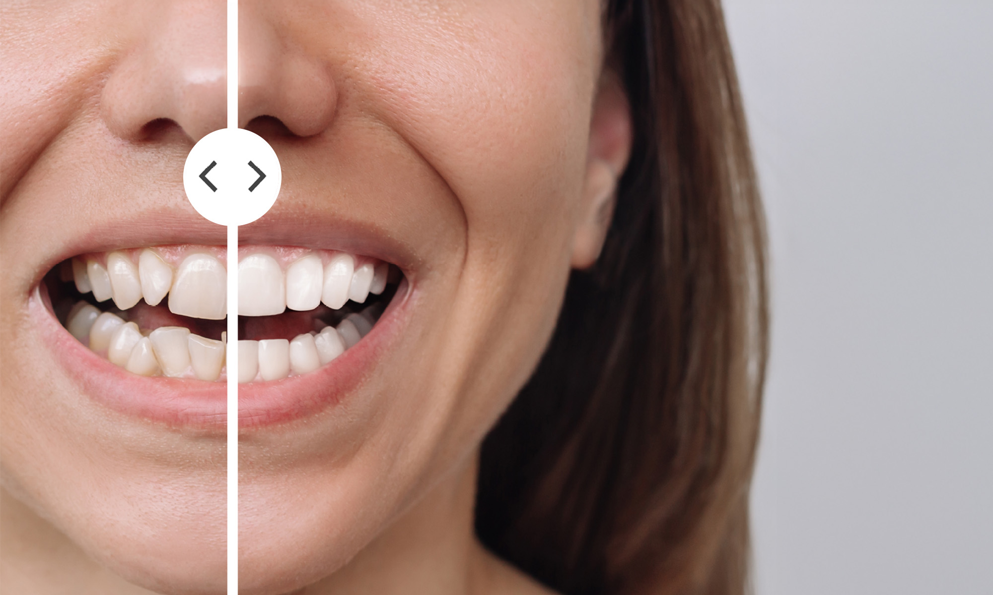 AlgoSmile smile simulation: the patient's current smile beside the projected result